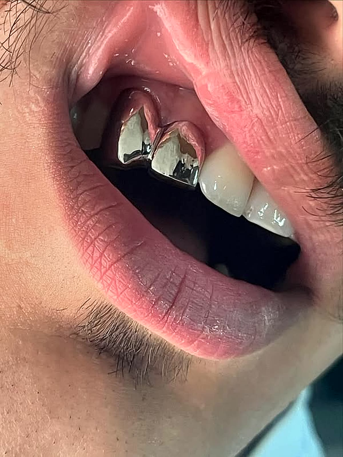 Custom grillz: Side pair · high shine