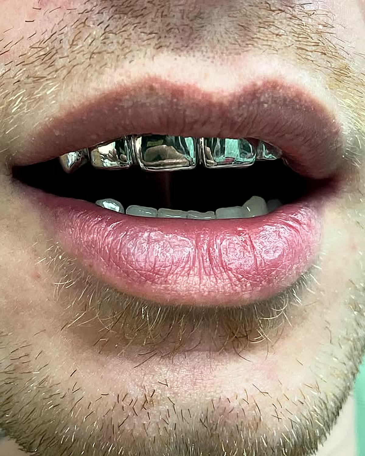 Custom polished silver grillz top row fitted on a client